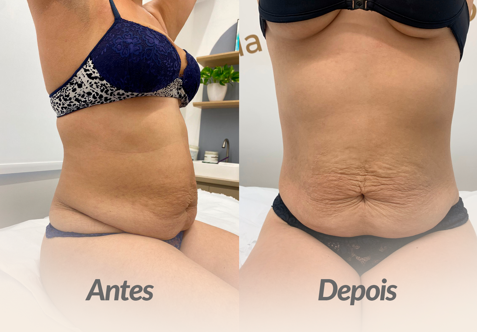 ABDOMEN-PACIENTE-2.png