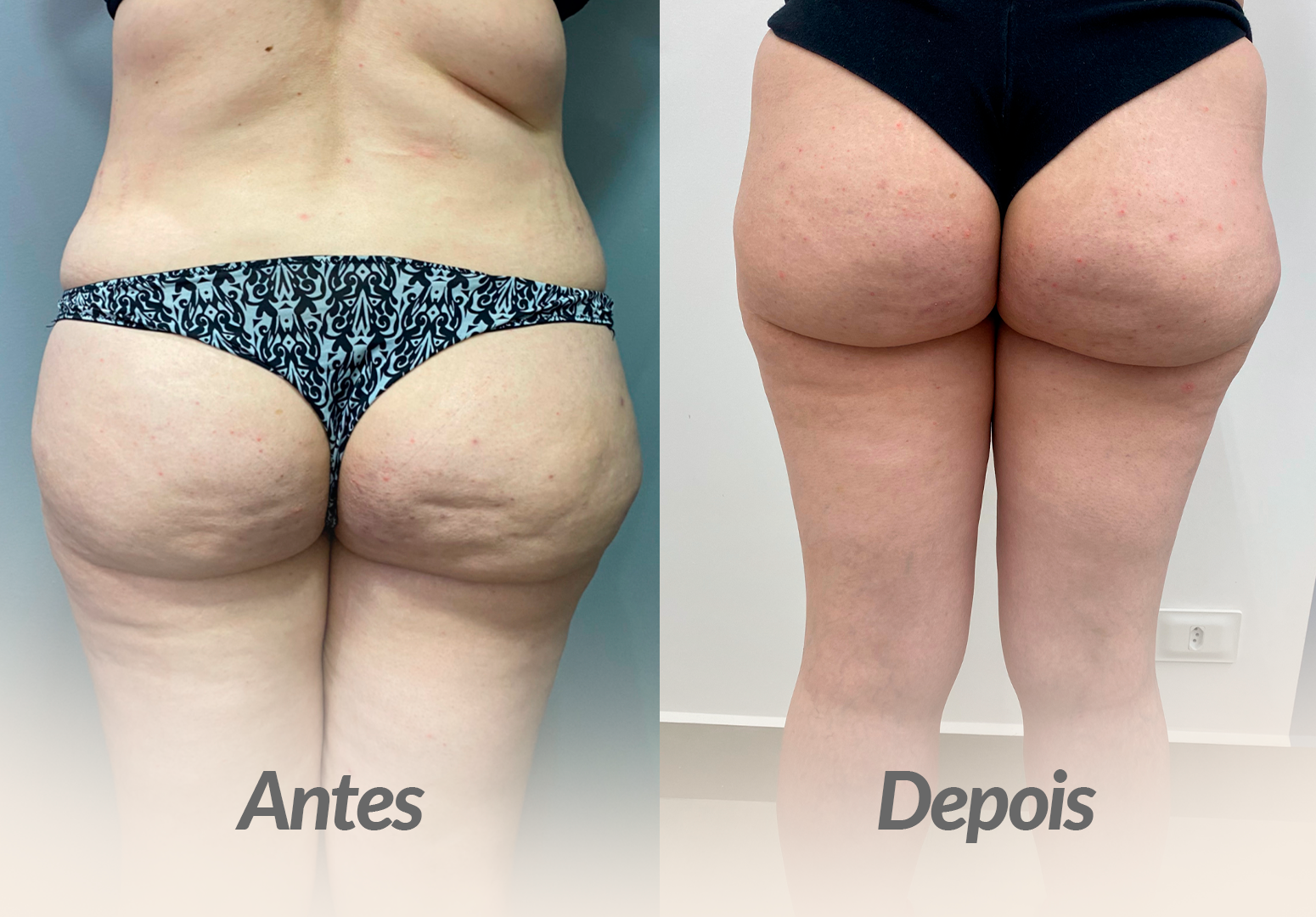 ANTES-E-DEPOIS-BIANCA.png