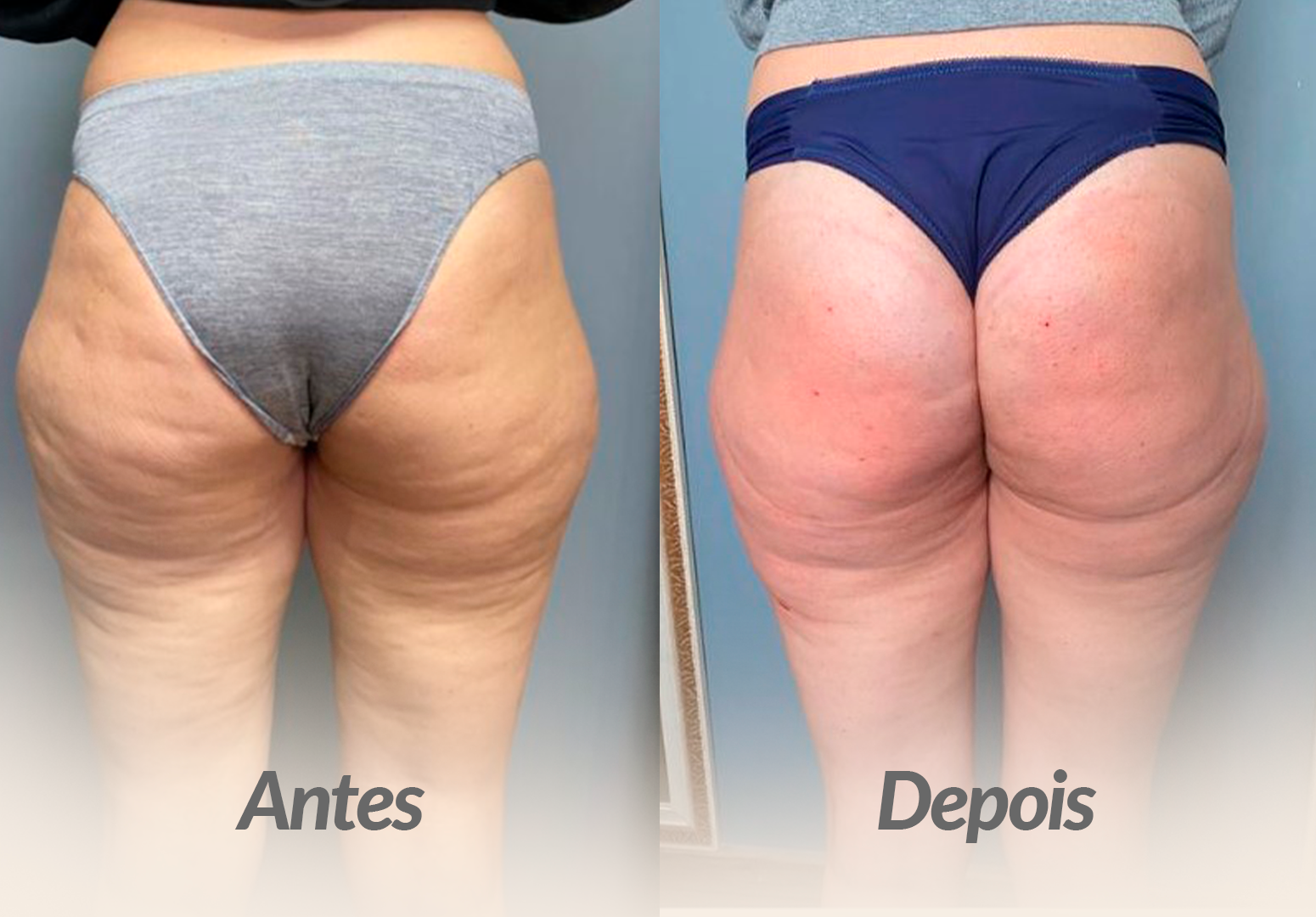 CULOTE-PACIENTE-1.png