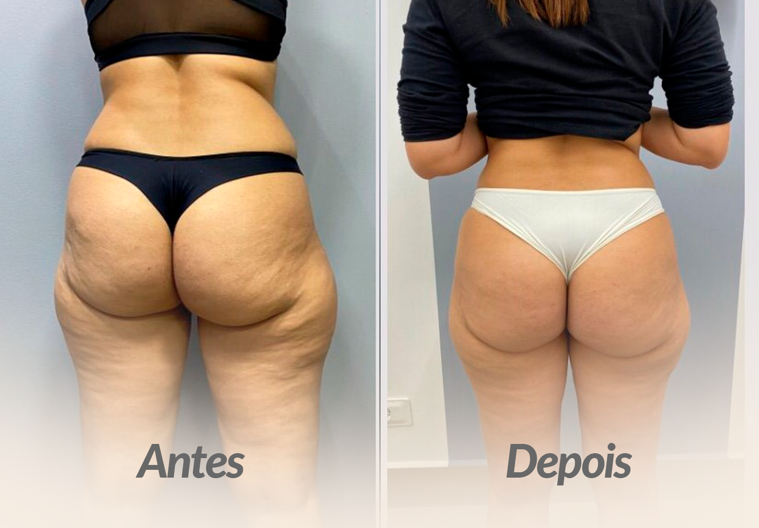 CULOTE-PACIENTE-2.png